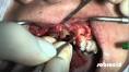 <b>aumento</b> de <b>coroa clinica</b>