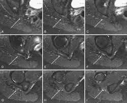 Attēlu rezultāti vaicājumam “Cribraria piriformis young”