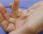 <b>Dupuytren's</b> Disease