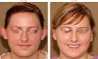 Otoplasty (Ear Setback) - Before and AFTER Pictures | Dr Turowski.
