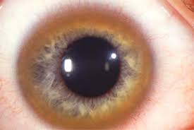 Kuvahaun tulos haulle Kayser-Fleischer