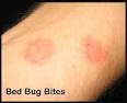 MoonDragon's Health &amp; Wellness: Insect Bite