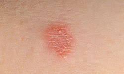 Image result for tinea corporis