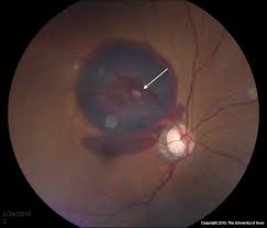 Attēlu rezultāti vaicājumam “Reticularia jurana macro”