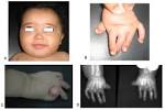 RARE DISEASES: CHAMBER APPROVES MOTION TO CONTRAST | Health Parley ...