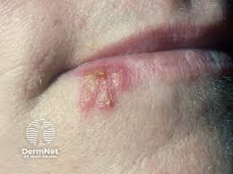 Attēlu rezultāti vaicājumam “Diderma simplex”