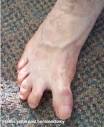 <b>Hallux varus</b>: An inward