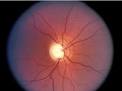 <b>Ocular hypertension</b> also known