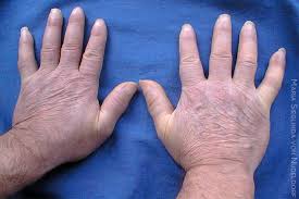 Attēlu rezultāti vaicājumam “Scleroderma”