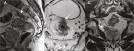 <b>rectal neoplasms</b> showing