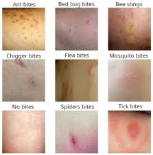 Image result for bed bug bites