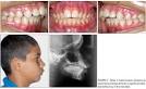 <b>Maloclusión</b> De <b>Angle Clase</b> Ii