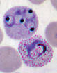 Left: <b>P</b>. <b>vivax</b> in early