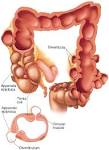 What is Diverticulosis?