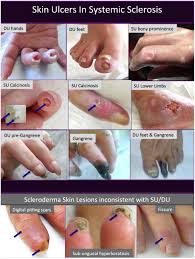 Attēlu rezultāti vaicājumam “Scleroderma”