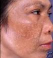 AILESBURY COSMETIC: 'Hyperpigmentation explained' by Dr. Patrick ...