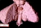 da <b>neurocisticercose</b> o IV