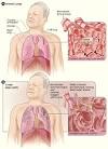 What Is COPD? - NHLBI, NIH