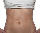 for <b>eczema</b> flare ups.