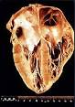 An acute <b>Chagas disease</b>