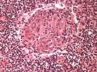 Histoplasmosis <b>Granuloma</b>