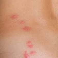 Image result for bed bug bites