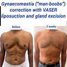 Image result for manboobs