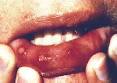 foot and <b>mouth disease</b>?