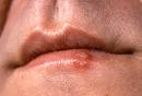 Picture of Cold Sores (Fever Blisters)