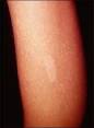 <b>Esclerosis tuberosa</b>; mácula