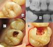 Dental caries - Wikipedia, the free encyclopedia