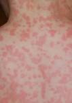 http://upload.wikimedia.org/wikipedia/commons/a/ac/Amoxicillin_rash_11_hours_after_17th_dose.JPG