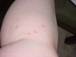 Image result for bed bug bites