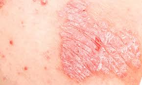 Attēlu rezultāti vaicājumam “Pemphigus borealis”