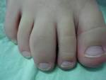 <b>Juvenile Rheumatoid Arthritis</b>