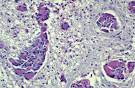 Lysosomal storage diseases