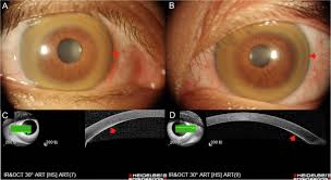 Kuvahaun tulos haulle Kayser-Fleischer
