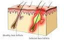 The Best Way To Get Rid of Blackheads On Nose - New Secret Method f,