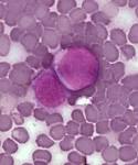 <b>Leukemia</b> Cells