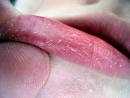 Chapped lips refer to a common