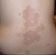 Attēlu rezultāti vaicājumam “Scleroderma”