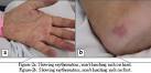 <b>Cholesterol Emboli</b> Syndrome