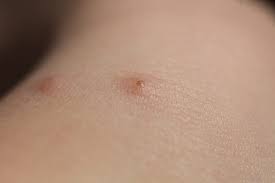 Image result for bed bug bites