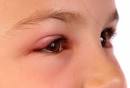Pictures of <b>Eyelid</b> Swelling :