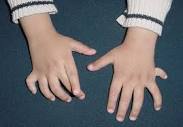 Multidisciplinary management of congenital hand anomalies - Mayo ...