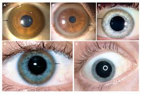 Kuvahaun tulos haulle Kayser-Fleischer