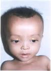 of <b>Zellweger syndrome</b>.