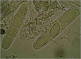 Attēlu rezultāti vaicājumam “Pertusaria leioplaca”