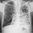 <b>emphysema</b> and irregular