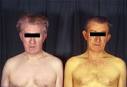 Gilbert's syndrome - Resources - Image - Best Practice - English